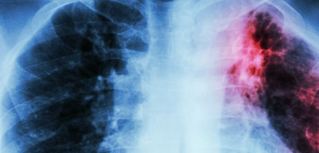 Lagos is Nigeria’s Tuberculosis epicentre — Official